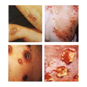 syphilis symptoms