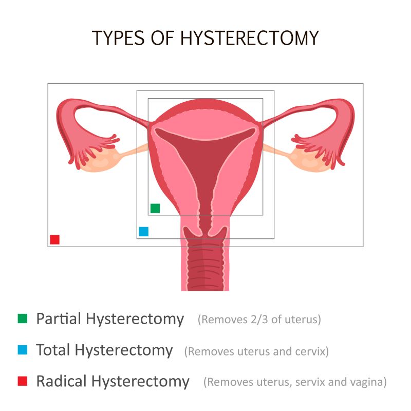 types of hysterectomy_165576441