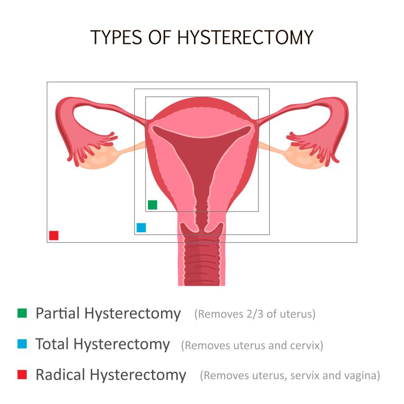 Hysterectomy - Cherokee Women's Health