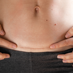 c-section scar