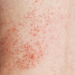 rash from incontinence