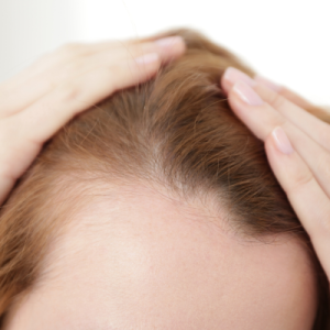 postpartum hair loss